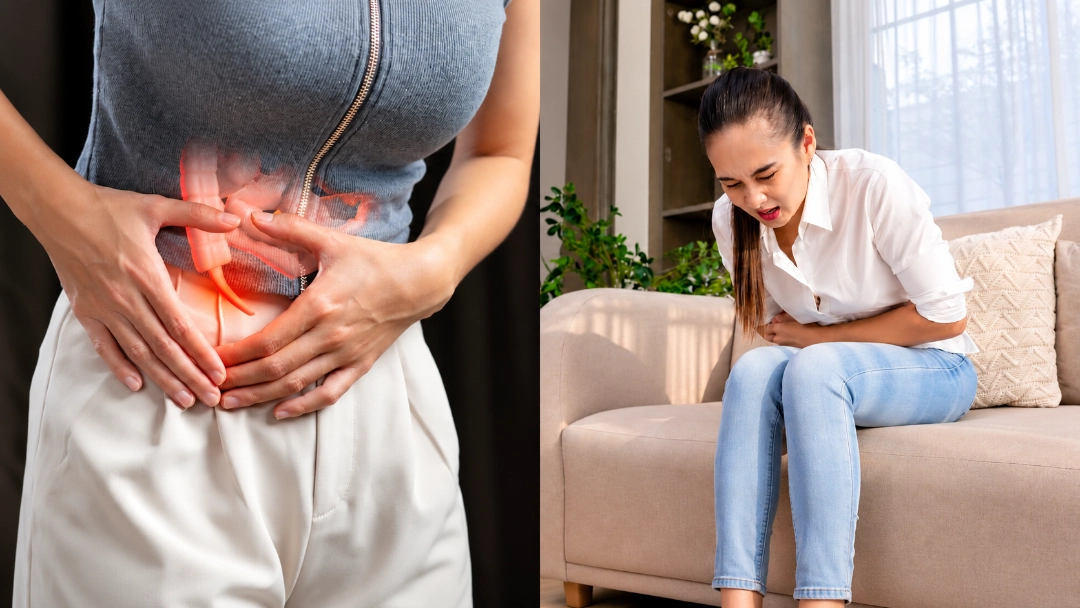 Ilustración Médica Apendicitis Aguda