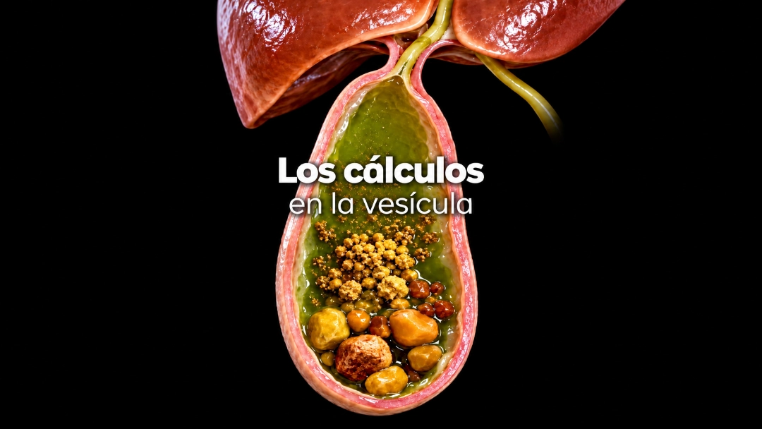 Ilustración Médica Colecistitis y Vesícula Biliar